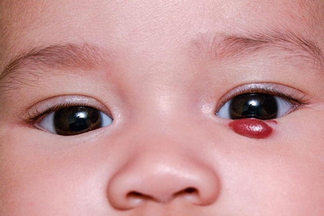 U máu vùng hàm mặt ở trẻ có cần điều trị?